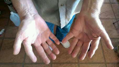 Meet The Man With Six fingers [PHOTOS]