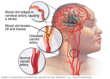 Stroke: Early identification of symptoms prevents loss of life – expert