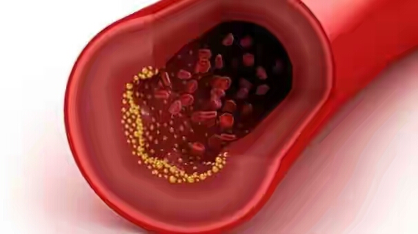 HURRAY! New Injection Cuts Bad Cholesterol To Lowest Levels Ever