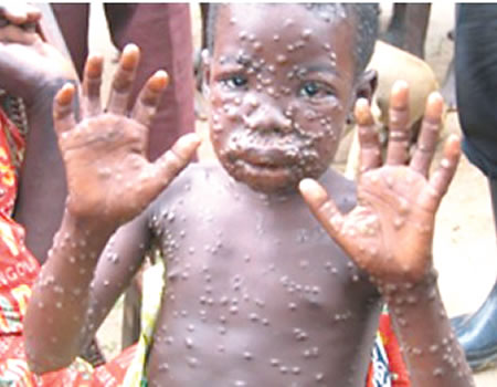 Monkey Pox hits Delta state, six suspected cases recorded