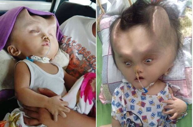 Baby left with devil horns after undergoing surgery