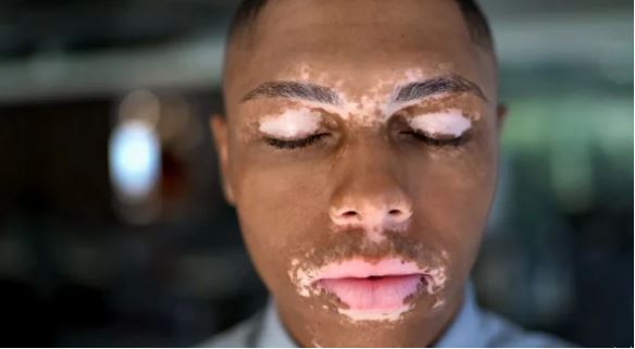 8 common myths and facts about vitiligo