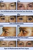Images of Eyelid Surgery Covered by Insurance