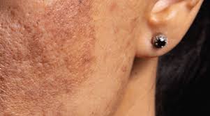 Sea Spot Saver for Stubborn Sunspots and Hyperpigmentation